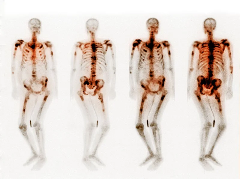 Scan, Metastatic Cancer