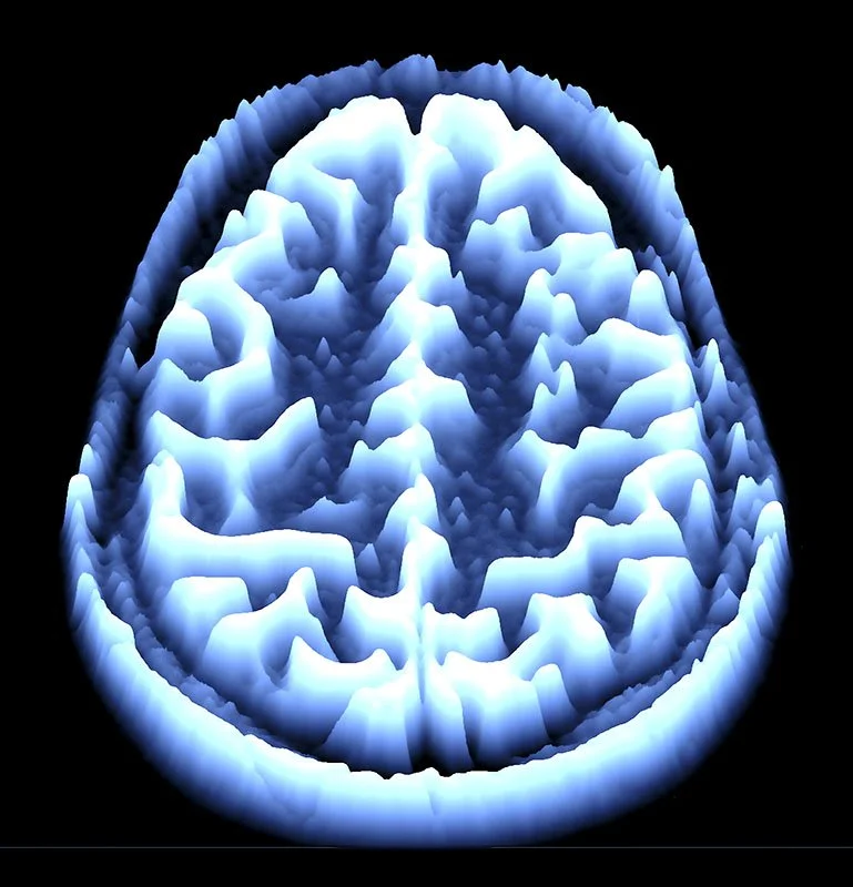 MRI Brain Scan
