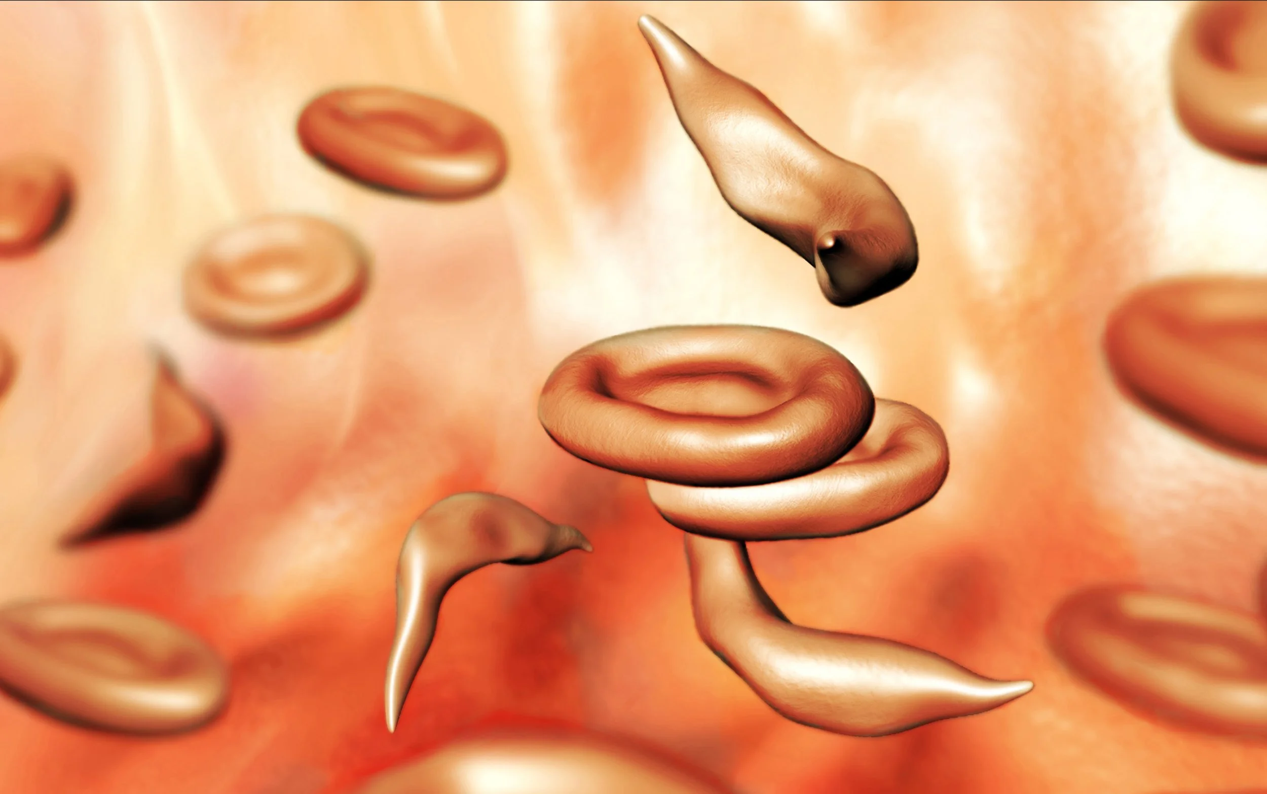 Sickle-cell-4.jpg