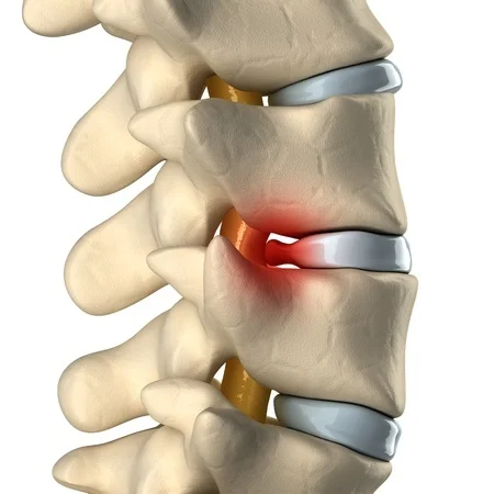 Bulging Disc - Ultimate Health Personal Training Center- Los Angeles