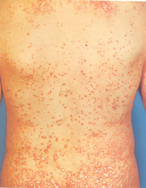 Guttate_psoriasis.jpg