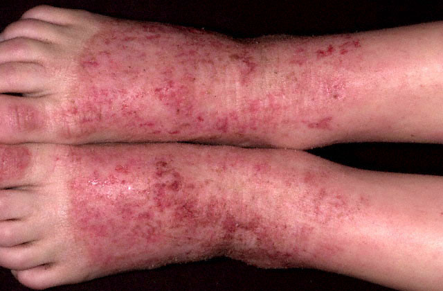 Atopic derm-2.jpg