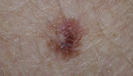 melanoma-in-situ-450.jpg