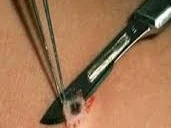 shave%2Bbiopsy.jpg