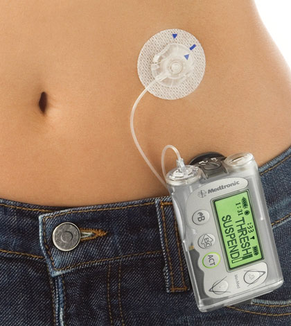 how many diabetics use insulin pumps