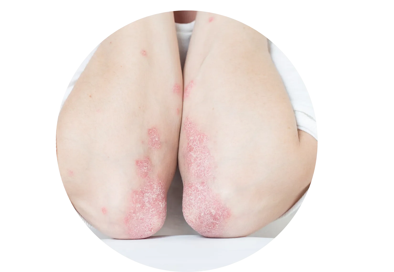 bare elbows showing a skin rash