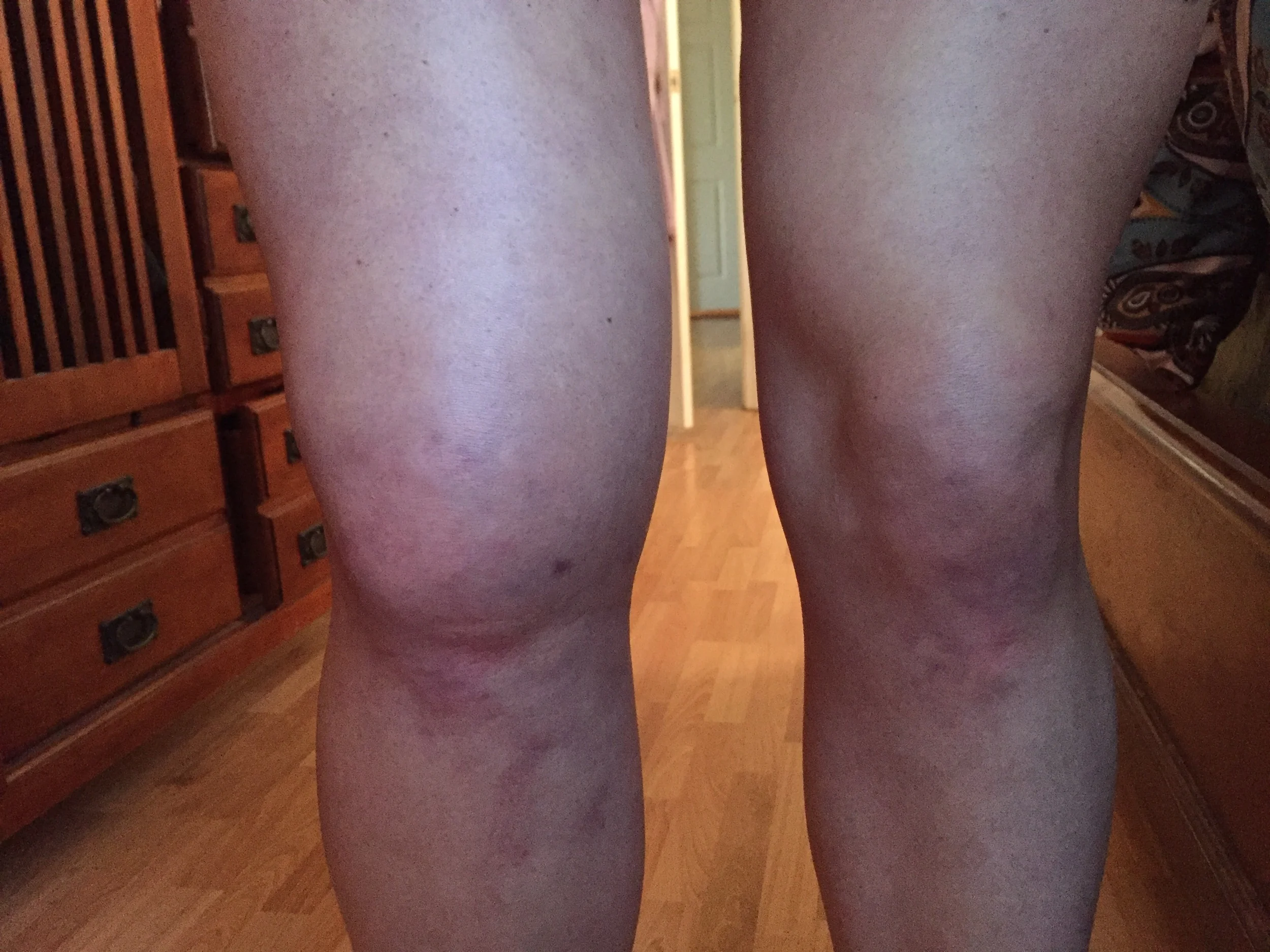 Day 4 swelling!