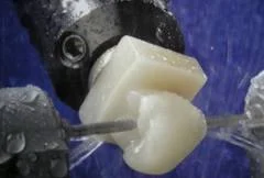 On site millingCEREC automatically mills the restoration out of a tooth-coloured ceramic block.