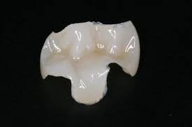 Characterisation Porcelain stain is applied as appropriate and blended across the surface of the crown. A porcelain glaze is also incorporated to give the completed crown a smooth, natural feel.