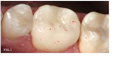 FitFinally, the restoration is inserted into your tooth and polished. The finished ceramic restoration look sand feels exactly like natural dental enamel.