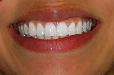 After treatment.