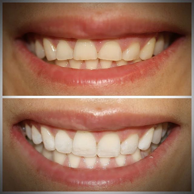 Good Morning Everyone!
Another Smile Enhanced by Dr Raj Panesar @thehubdentalrooms.
Treatment: teeth Whitening and Composite Bonding. 
COME AND SEE WHAT'S POSSIBLE!
☎️ 02089620000
======================================
#thehubdentalrooms #dentalclini