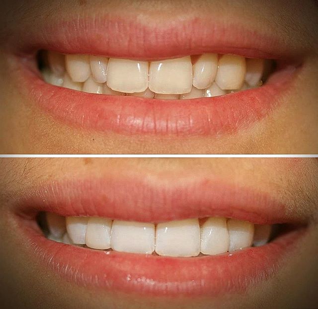 Can you spot the difference?
A Subtle Change that Worked Wonders!! 👌😍
Composite Bonding and Whitening Treatment on the laterals teeth by Dr Roberta McKeown 🙌 @thehubdentalrooms 
COME AND SEE WHAT'S POSSIBLE!
☎️ 02089620000
========================