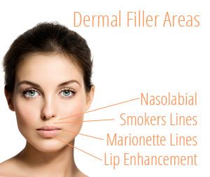 dermal-filler-areas-300x253.jpg