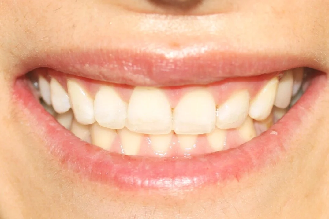 After Composite Bonding.  Photography And Treatment by Dr Raj Panesar