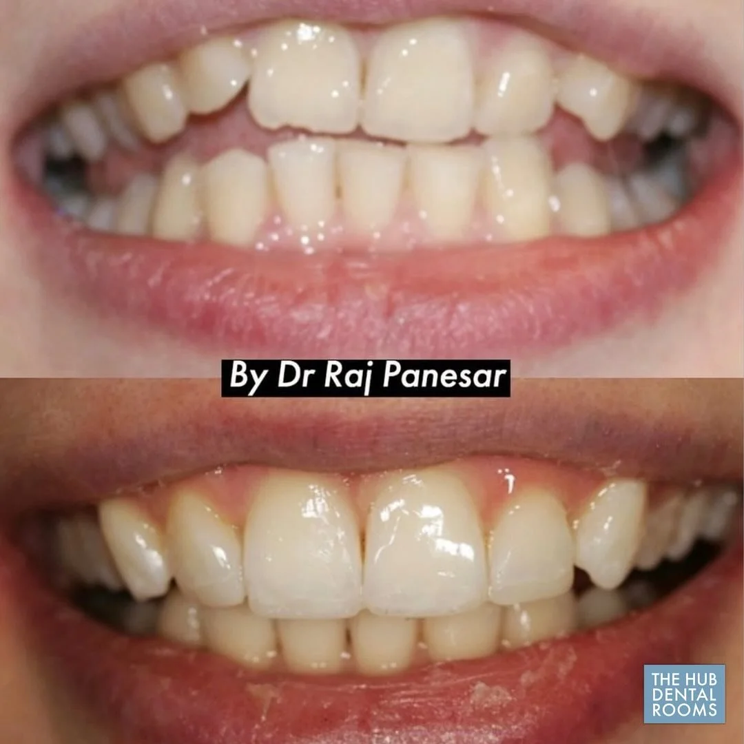 ⚡️It&rsquo;s incredible what the right treatment can do!&nbsp;

😁 This smile transformation is a true testament to the care and expertise we offer. Ready for your own transformation?

Book your consultation today by calling our friendly receptionist