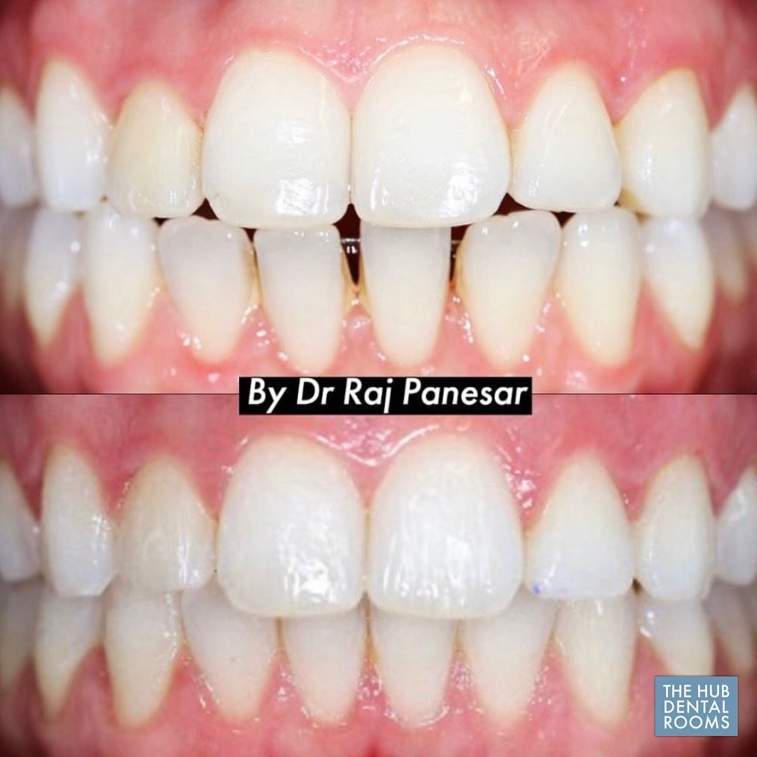 🦷 See the difference for yourself &ndash; a brighter, healthier smile in just one visit.

💥 This December, take advantage of our special offer: Teeth whitening for just &pound;299 till January 31st 2025 (usually &pound;375). 

👉 Keep your smile sp
