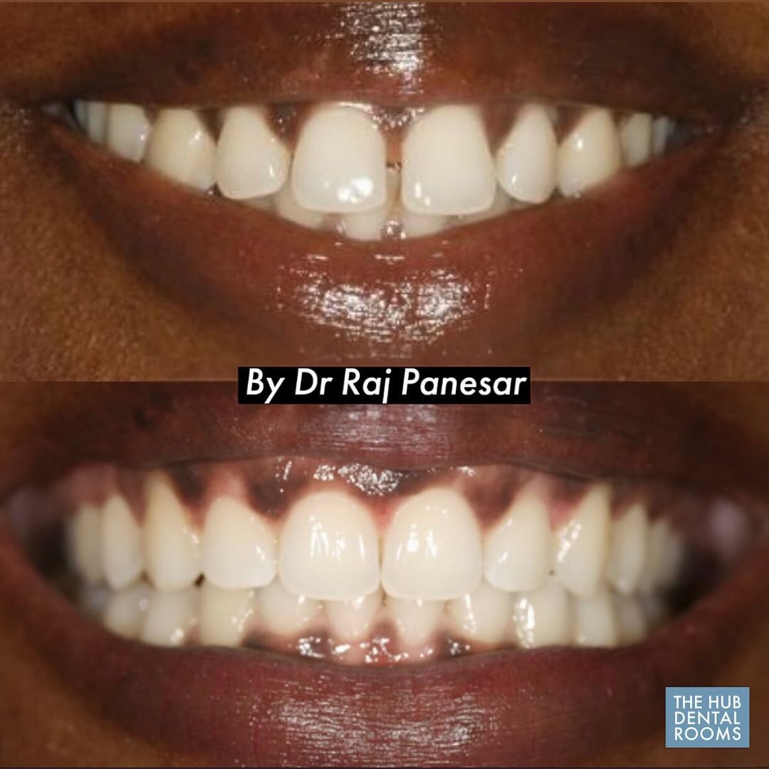 🪄A stunning smile transformation &ndash; proof that expert care can make all the difference.

✔️ From restoring confidence to enhancing overall dental health, we offer tailored treatments to meet your needs.

🦷 We provide the latest technology on a