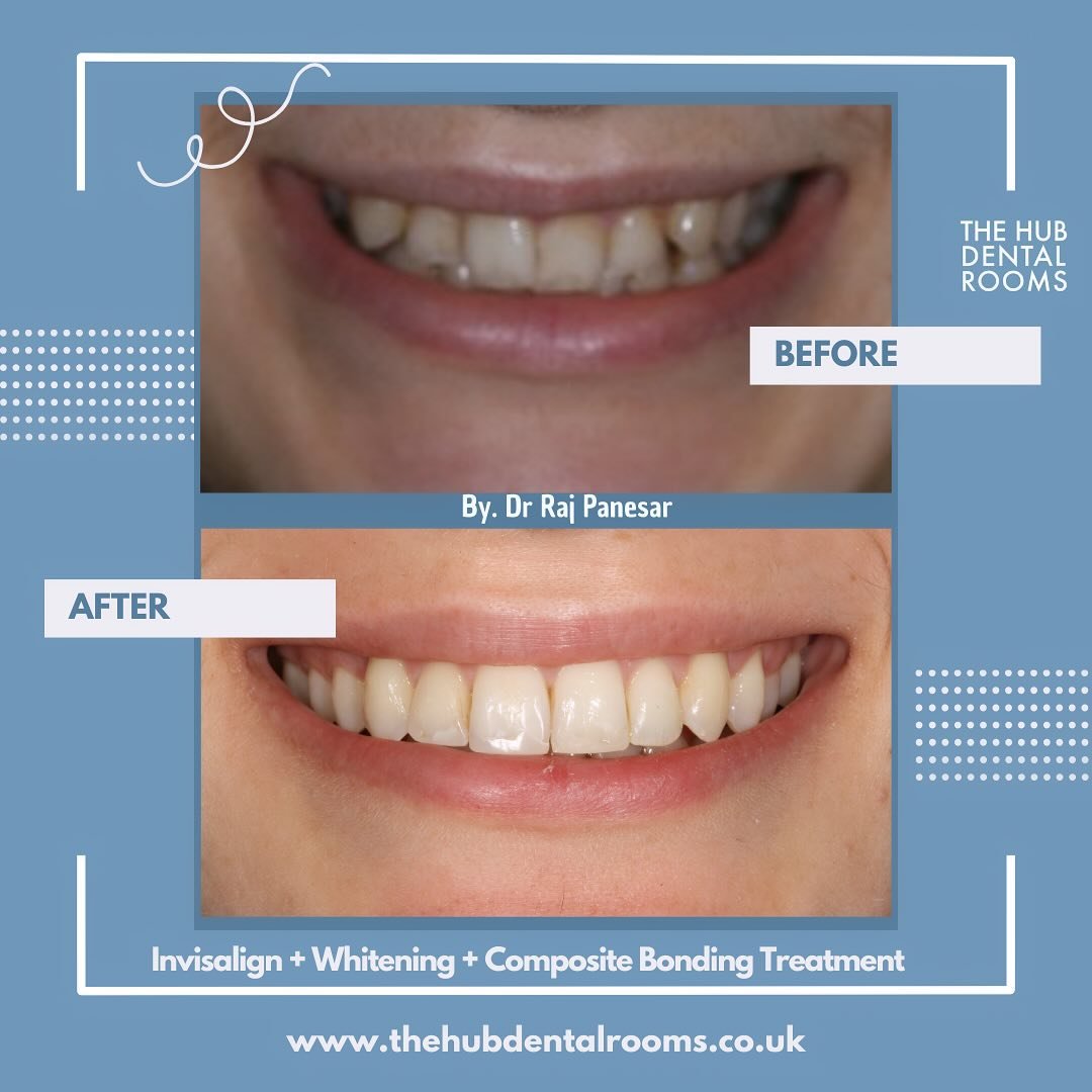 Walking into Friday mood like... 😍✨ 

We LOVE a good before &amp; after! See this stunning transformation with Invisalign + Whitening + Composite Bonding by Dr. Raj 🦷✨ 

Ready for your own smile glow-up? DM us to book your consultation!

#beforeand
