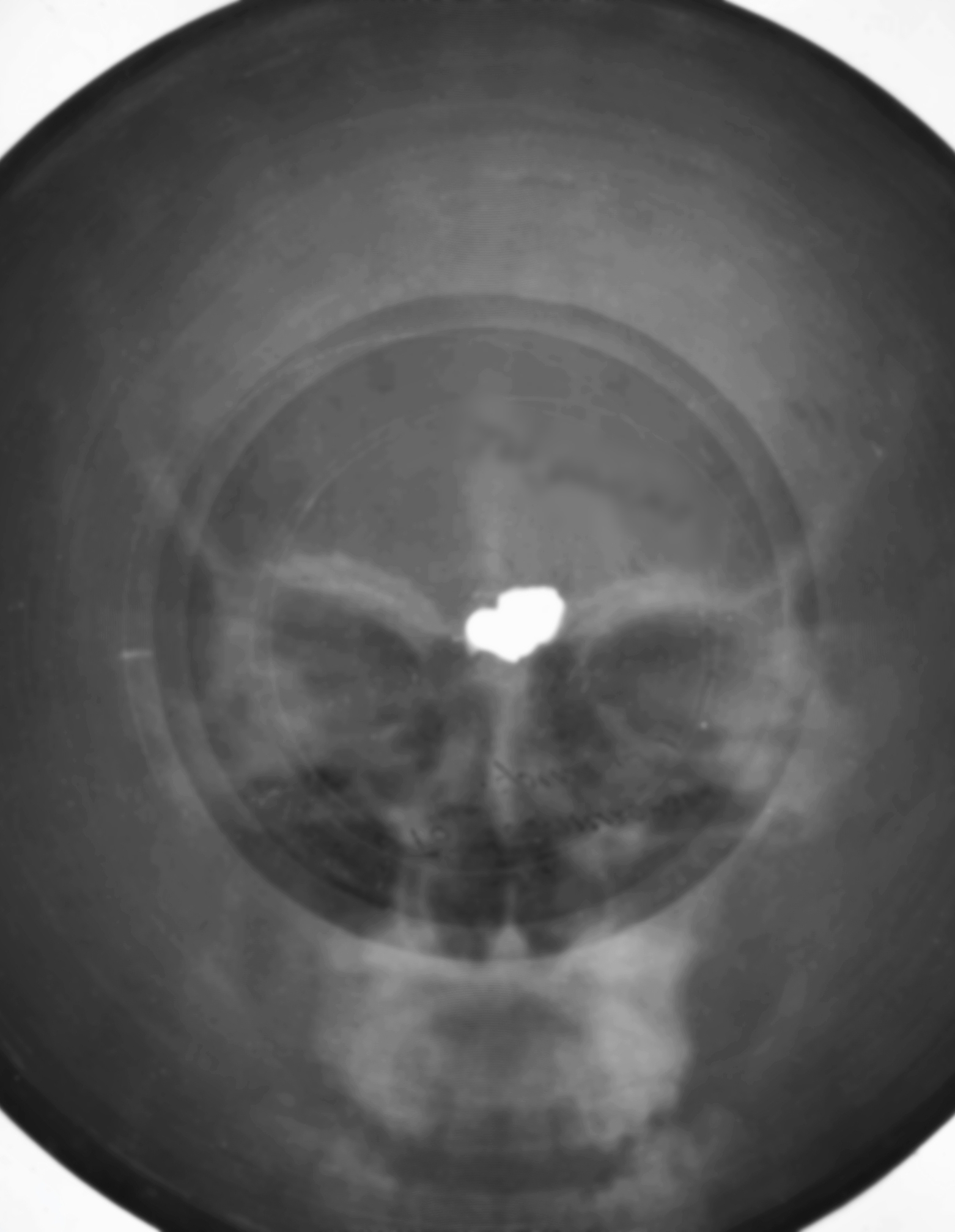 Kozin on x-ray record