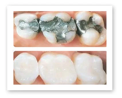 Dr. Koczarski can transform your smile with composite tooth-colored fillings. 