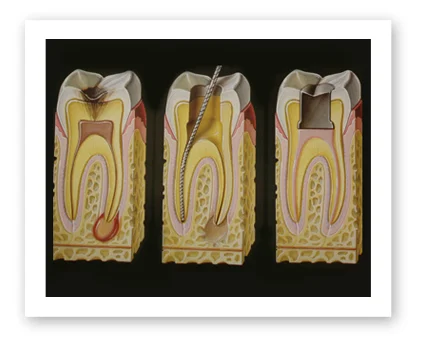 Dr. Koczarski provides pain-free root canals when necessary. 