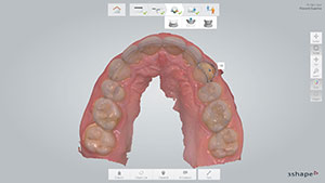 Figure 4. Occlusal view on screen of scanned maxillary arch (TRIOS).