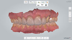 Figure 5. Anterior view of scan of both arches in occlusion (TRIOS).