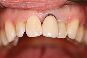 Figure 12a. Restoration design proposal tooth No. 9 (PlanScan).