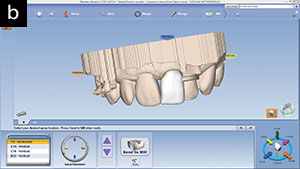 Figure 13a. Scan of the maxillary arch allowed for evaluation of preparation No. 9 (PlanScan)