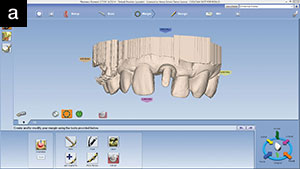.Figure 13b. Occlusal view after margins were identified.