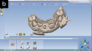 .Figure 13b. Occlusal view after margins were identified.
