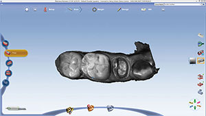 Figure 16. ICE view of scan of tooth prep (No. 29) allowed for precise evaluation of margin placement (PlanScan).