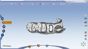 Figure 17. Virtual stone model view of prep, tooth No. 29.