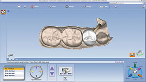 Figure 19. Assessment and adjustment of sprue placement, tooth No. 29.