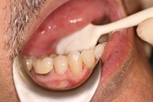 Figure 20. Final lithium disilicate (IPS e.max CAD) crown on tooth No. 29; completed and cemented at the same appointment.
