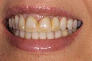 Figure 21. Pre-op polymethyl methacrylate temporary crowns, teeth Nos. 8 and 9.