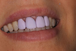 Figure 22. Try-in of the milled (PlanMill) lithium disilicate (IPS e.max CAD) crowns.