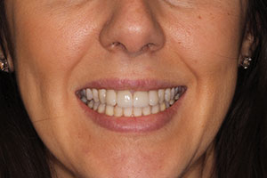 Figure 23. Final cementation was done at the same appointment (Adhese Universal and Variolink Esthetic) to complete the case.