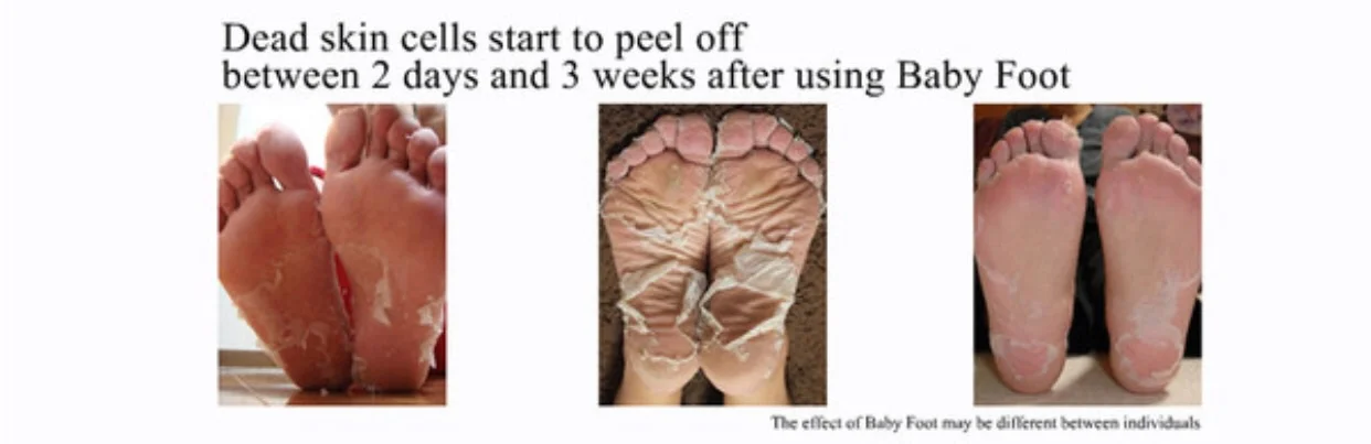 Don't forget to Facilitate this process soak your feet for 10 mins here and there. It helps looked the skin. Don not peel the skin. 
