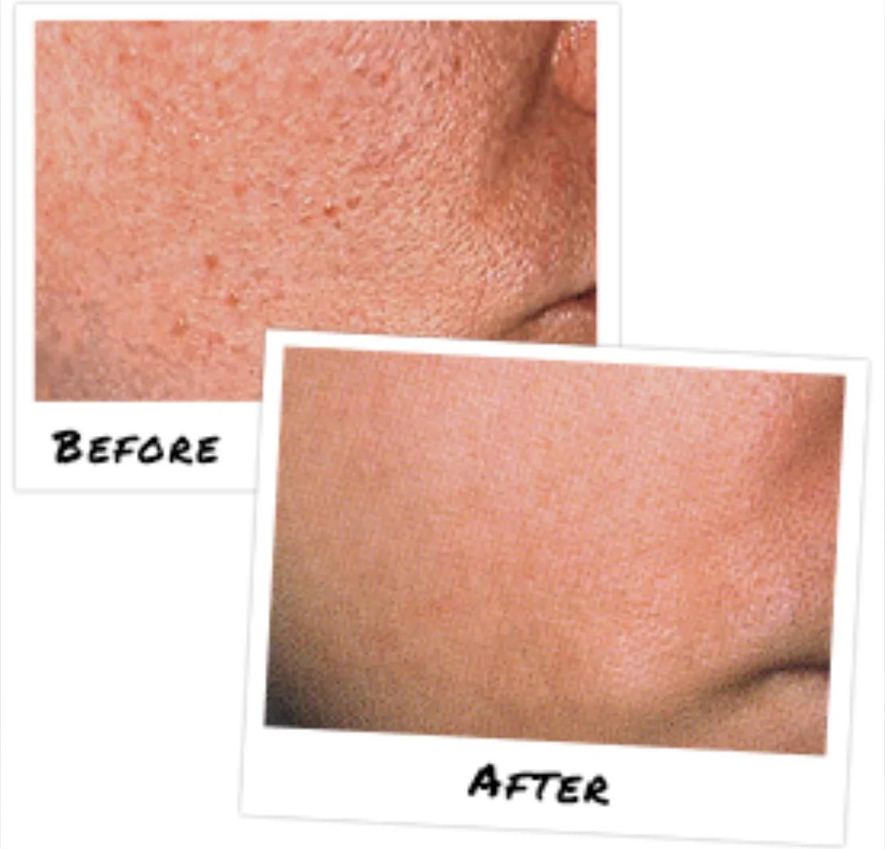 Treatment with salicylic acid.