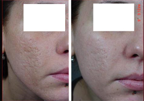 trattamento cicatrici acne