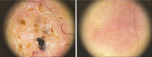 valutazione dermatoscopica prime e dopo trattamento della lesione a livello della tempia.
