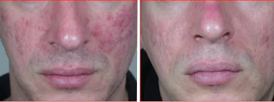 Rosacea dell’'adulto. Dopo sole 2 applicazioni. A 6 mesi dall’ultima applicazione