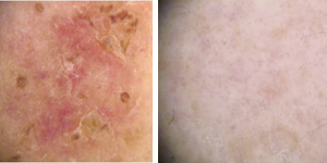 Dermatoscopia. Scomparsa della lesione