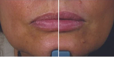 fillers3.jpg