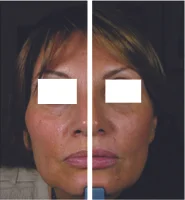 fillers2.jpg