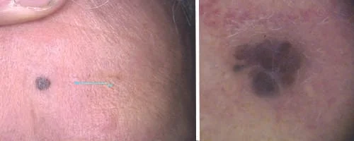 Melanoma Nodulare