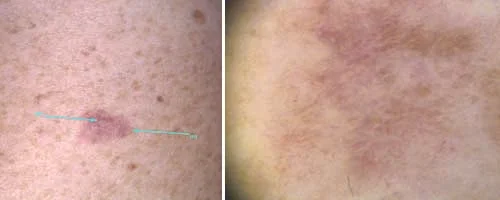 Melanoma Sottile