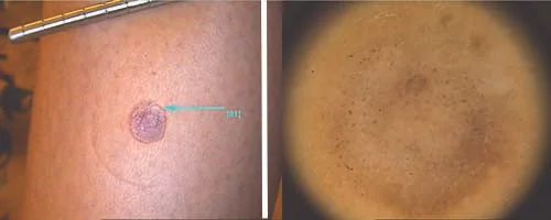 Melanoma Amelanotico